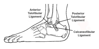 Ankle Sprain 